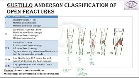 Gustilo Classification